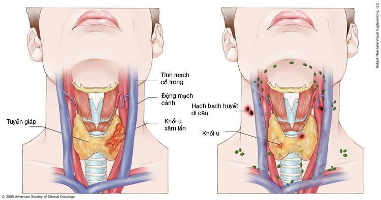 Các biện pháp phòng ngừa ung thư vòm họng