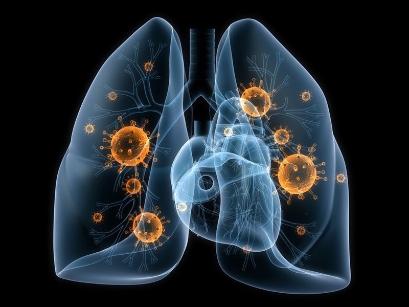 Điều trị và phòng tránh ung thư phổi