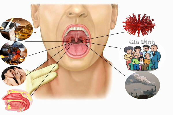 Những điều cần biết về ung thư vòm họng