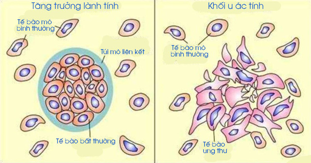 Phân biệt U lành tính và U ác tính