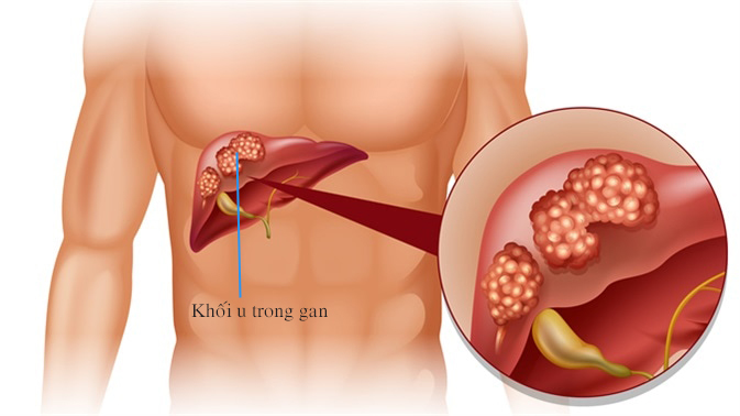 Phân biệt U lành tính và U ác tính