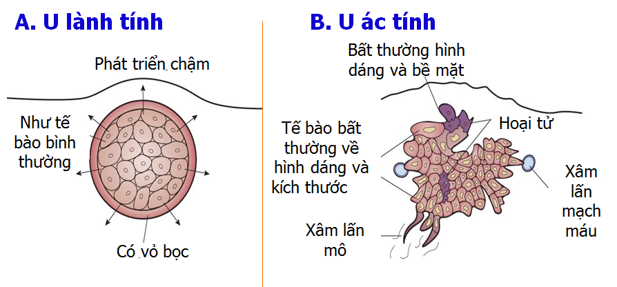 Phân biệt U lành tính và U ác tính