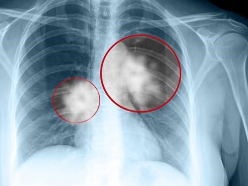 Các triệu chứng và cách phát hiện ung thư phổi